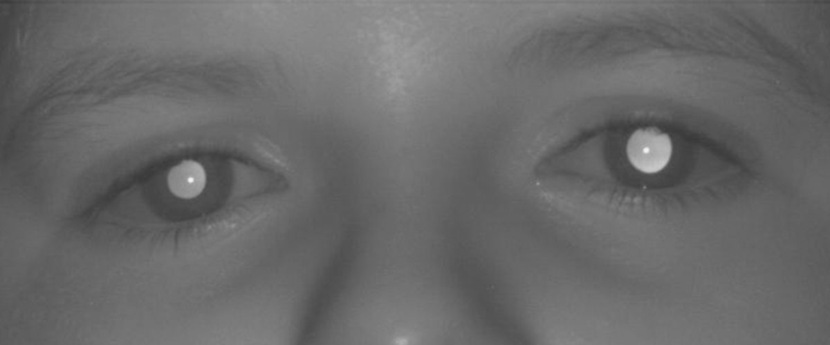 Grado De Discapacidad Por Ojo Vago Ojo Vago: parche Vs terapia visual - Natural Visión D+I